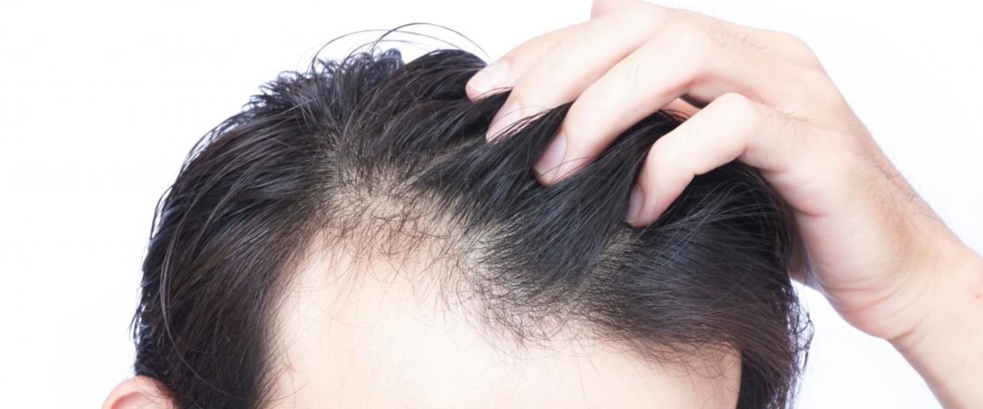 How do I know if hair loss is permanent?