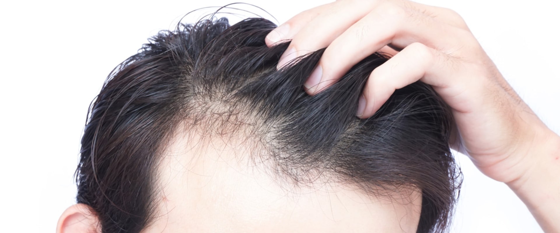 Is hair loss due to diet reversible?
