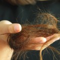 Is hair loss from weight loss permanent?