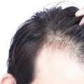 Is diet-related hair loss permanent